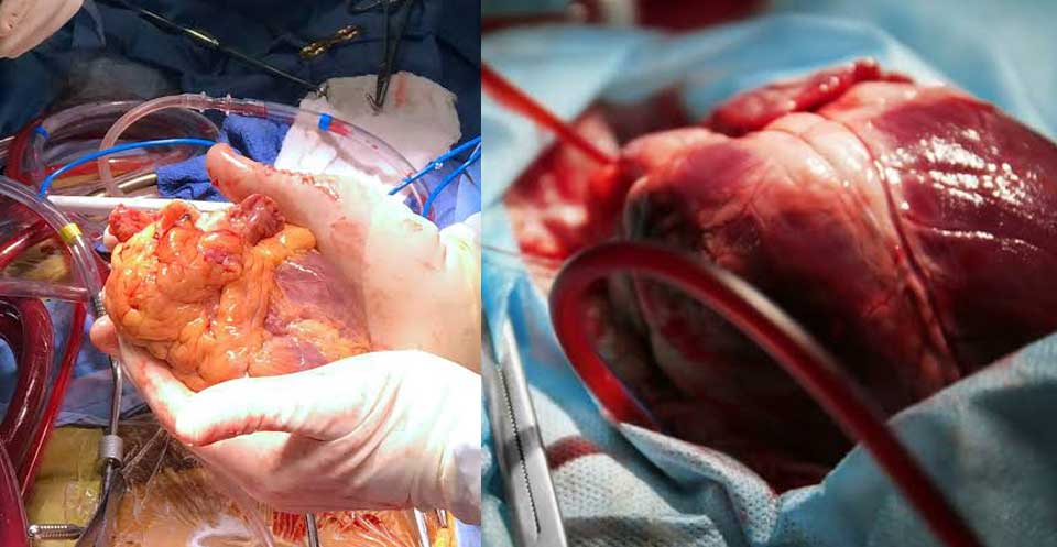 heart-transplantation